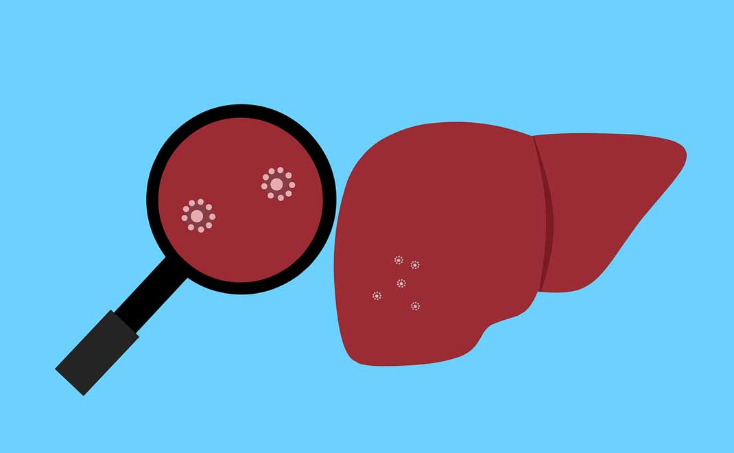 Hepatitis (Gambar: Mohammed Hasan/Pixabay)